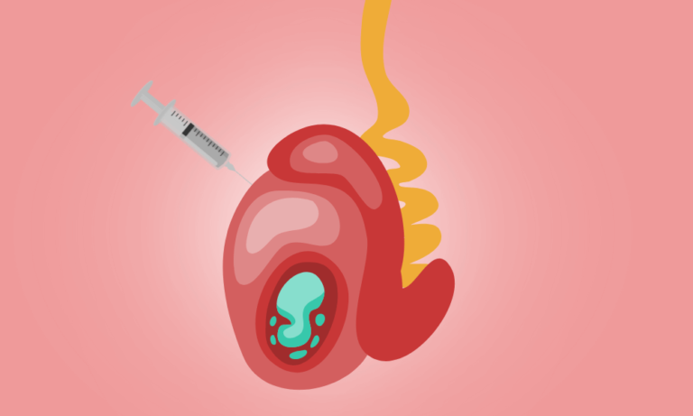 Pesa and Tesa Treatment in Bangalore